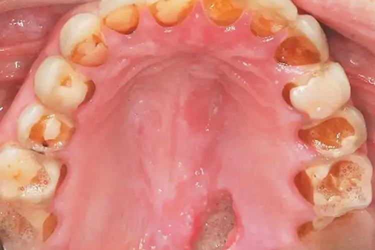 长期催吐牙齿受损腐烂图