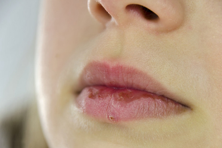慢性接触性唇炎图