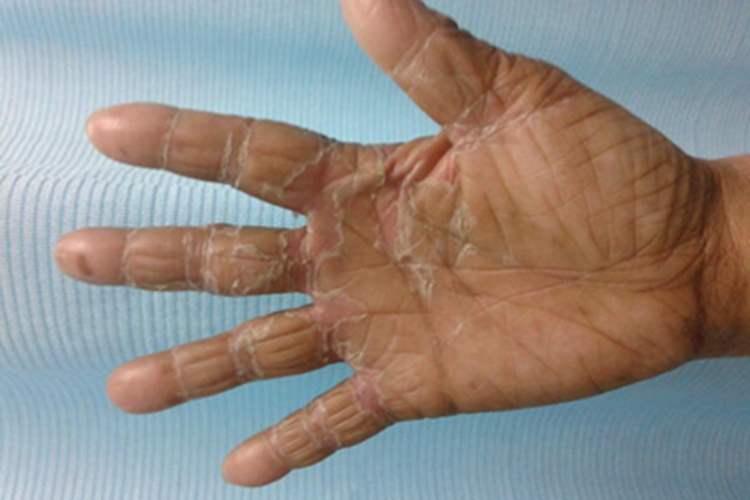 4级手足综合征手部干燥裂纹图