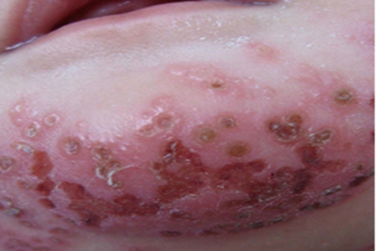 卡波西水痘样疹下巴结痂图