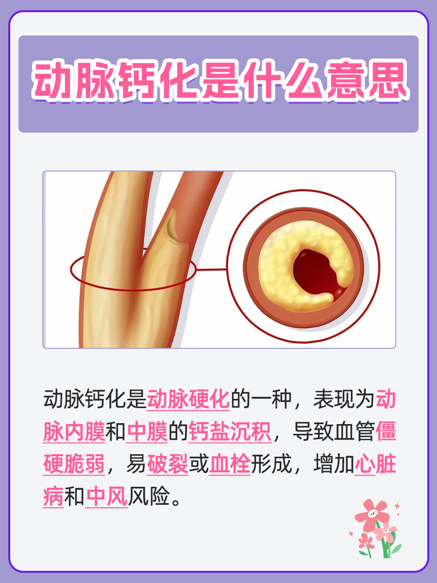 了解动脉钙化：动脉硬化的隐秘杀手