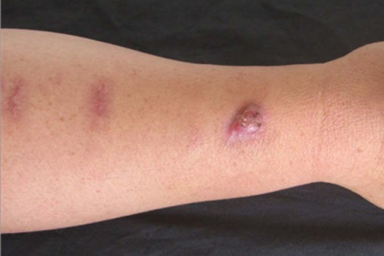 组织胞浆菌病疙瘩图 组织胞浆菌病疙瘩图