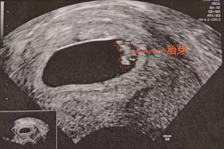怀孕7周有胎心胎芽图 怀孕7周有胎心胎芽图