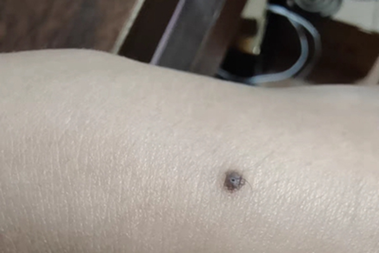 复合痣小疙瘩图 复合痣小疙瘩图