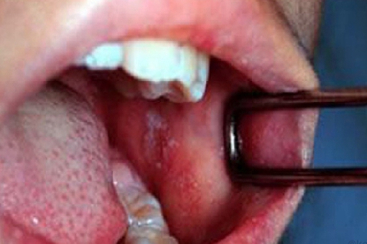 典型麻疹前驱期口腔症状图