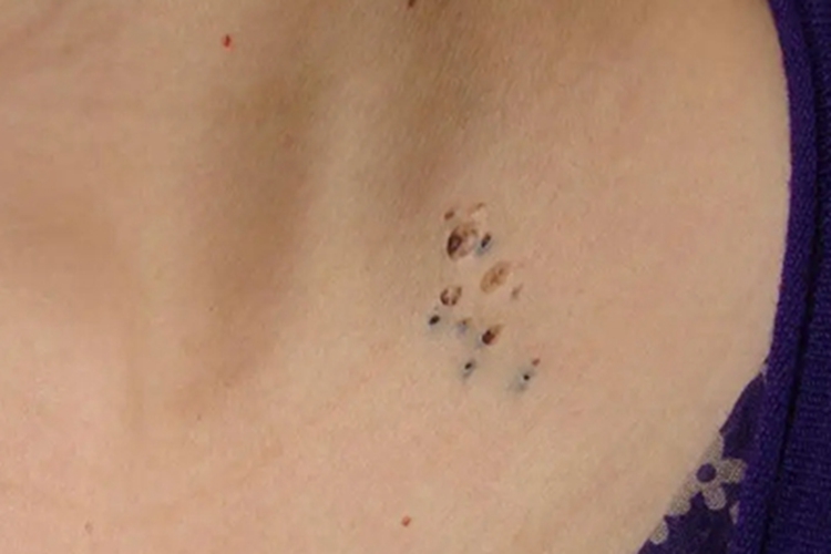 黑头粉刺痣胸部小坑图 黑头粉刺痣胸部小坑图