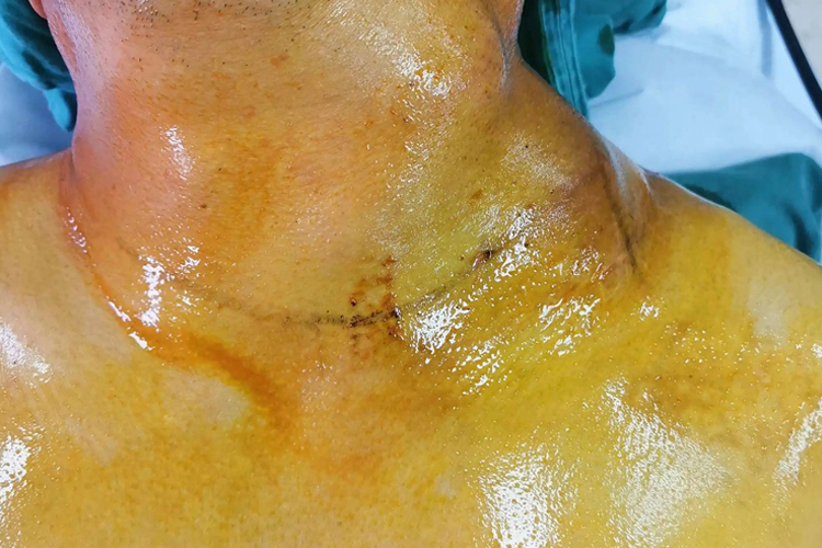 甲状腺手术消毒范围图