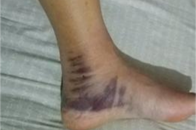 Ⅰ型踝关节骨折脚踝淤血图