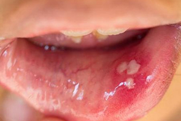 小儿口疮下嘴唇有白色溃疡图