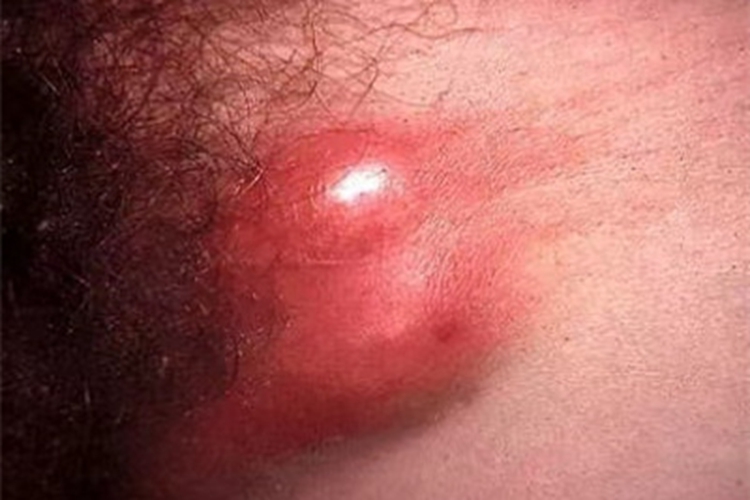 女性中期性病性淋巴肉芽肿症状图