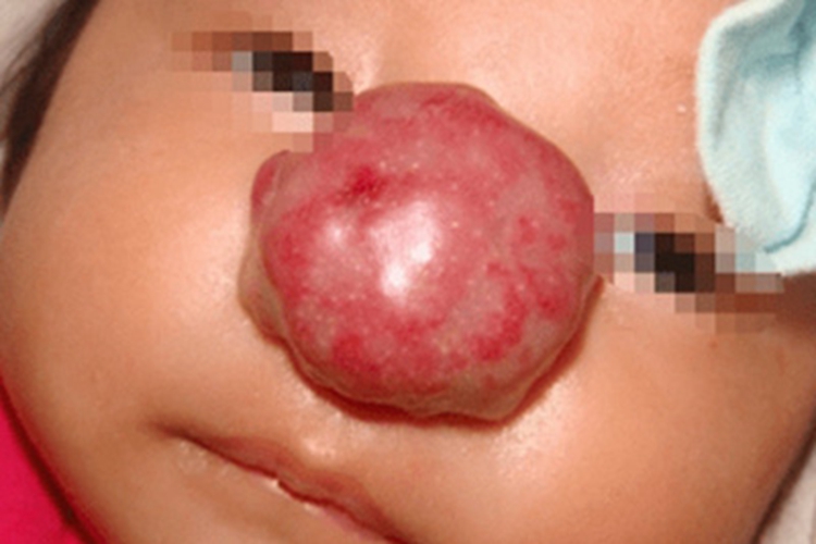 婴儿血管瘤面部肿块图