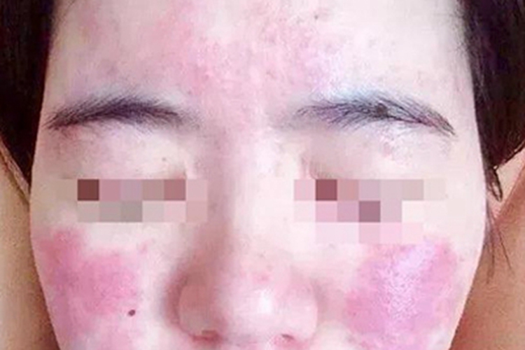 暴发性玫瑰痤疮面部红色斑片图