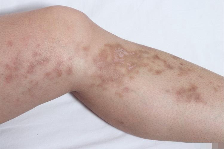 共济失调毛细血管扩张症小腿斑图 共济失调毛细血管扩张症小腿斑图