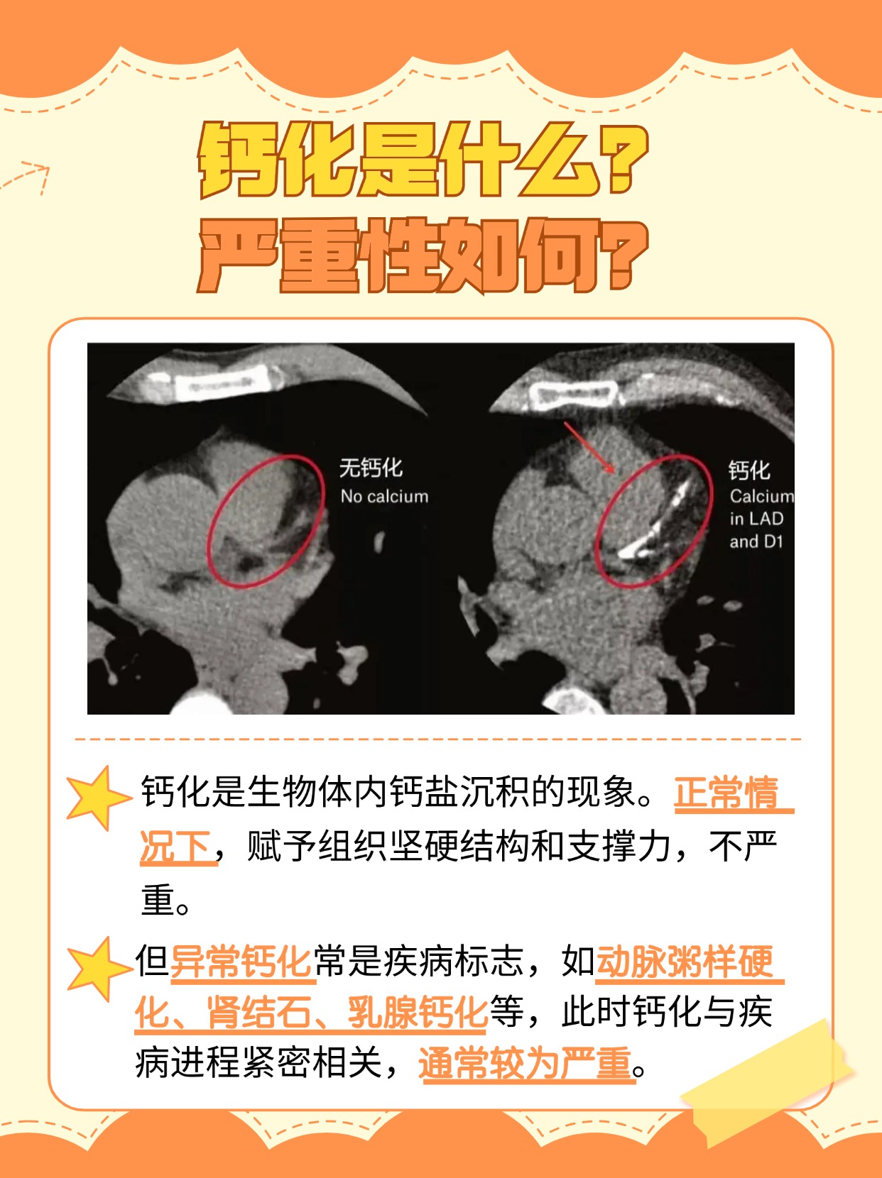 解析：钙化什么意思，严重吗？