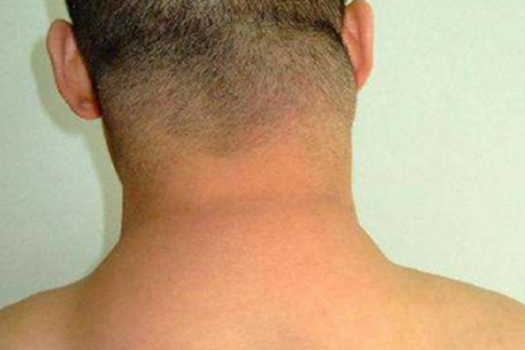 良性对称性脂肪过多症后颈包块图