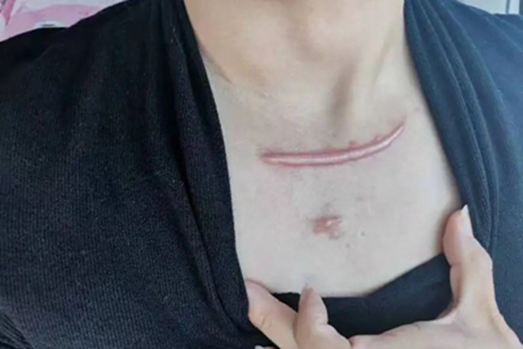 瘢痕疙瘩胸前有凸起性红斑图