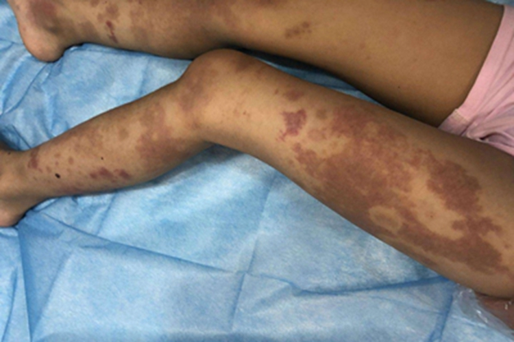 过敏性紫癜腿部斑图