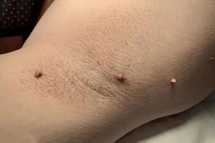 腋窝软纤维瘤图