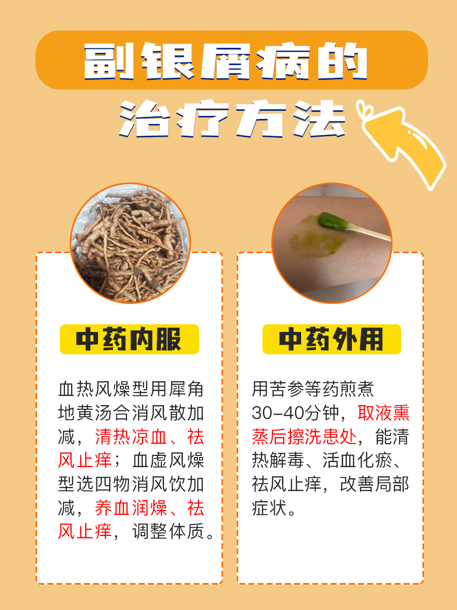 副银屑病咋处理?治疗妙招来啦!