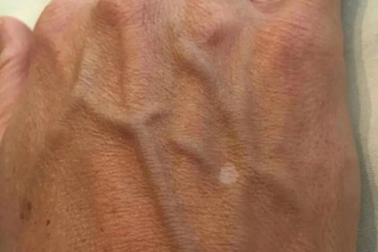 特发性点状色素减退斑手背症状图 特发性点状色素减退斑手背症状图