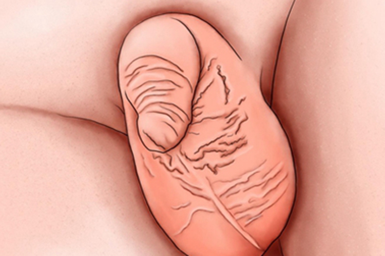 幼儿包茎图 幼儿包茎图