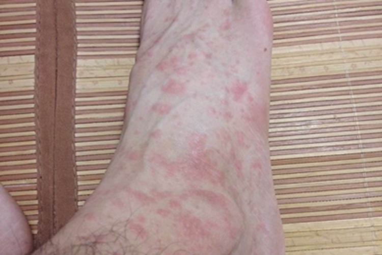 血吸虫病脚部风团图 血吸虫病脚部风团图
