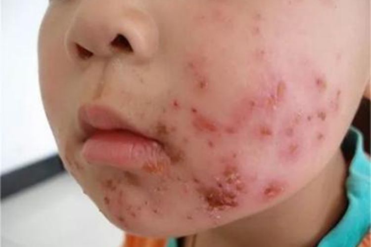 深脓疱疮面部水疱结痂图 深脓疱疮面部水疱结痂图