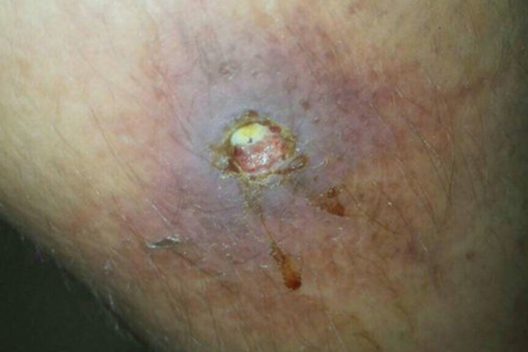 肌肉注射感染图