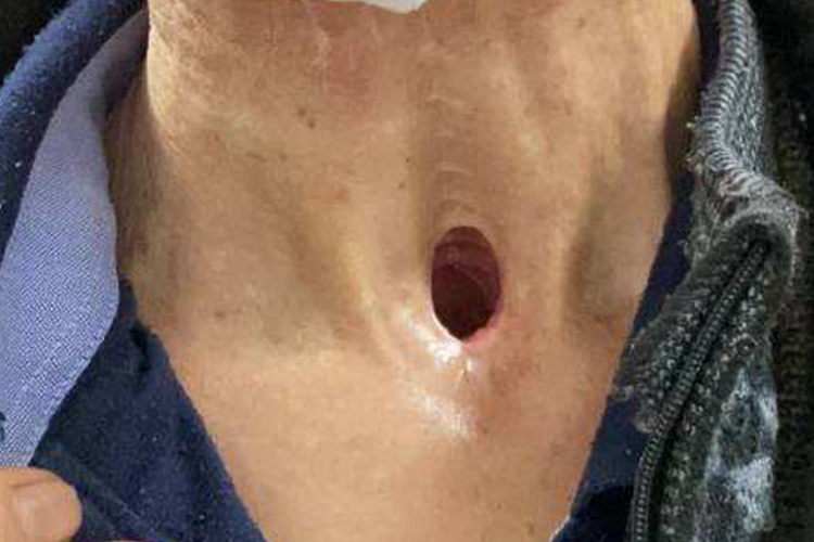 喉癌造瘘口恢复图