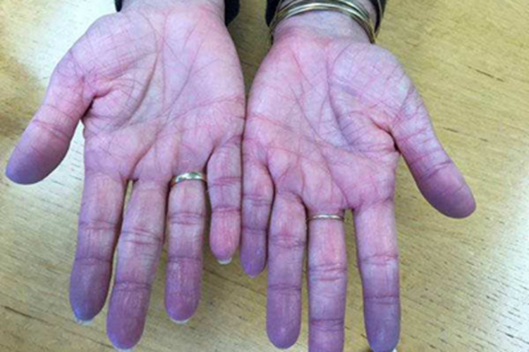 手足发绀症手掌症状图