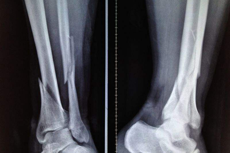 腓骨骨折骨折线模糊图 腓骨骨折骨折线模糊图