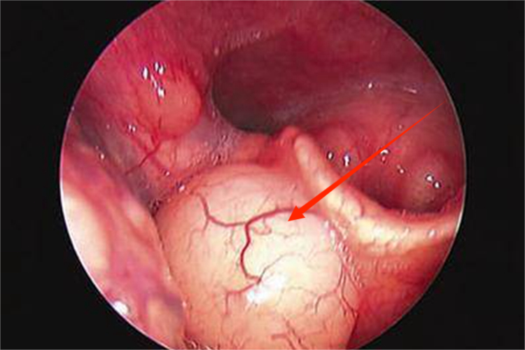 吃柿子过敏喉头水肿图 吃柿子过敏喉头水肿图