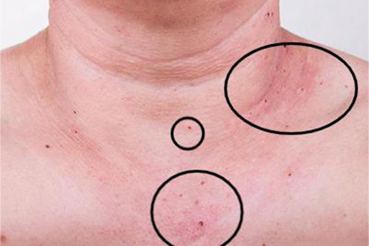 樱桃状血管瘤颈部小红疙瘩图