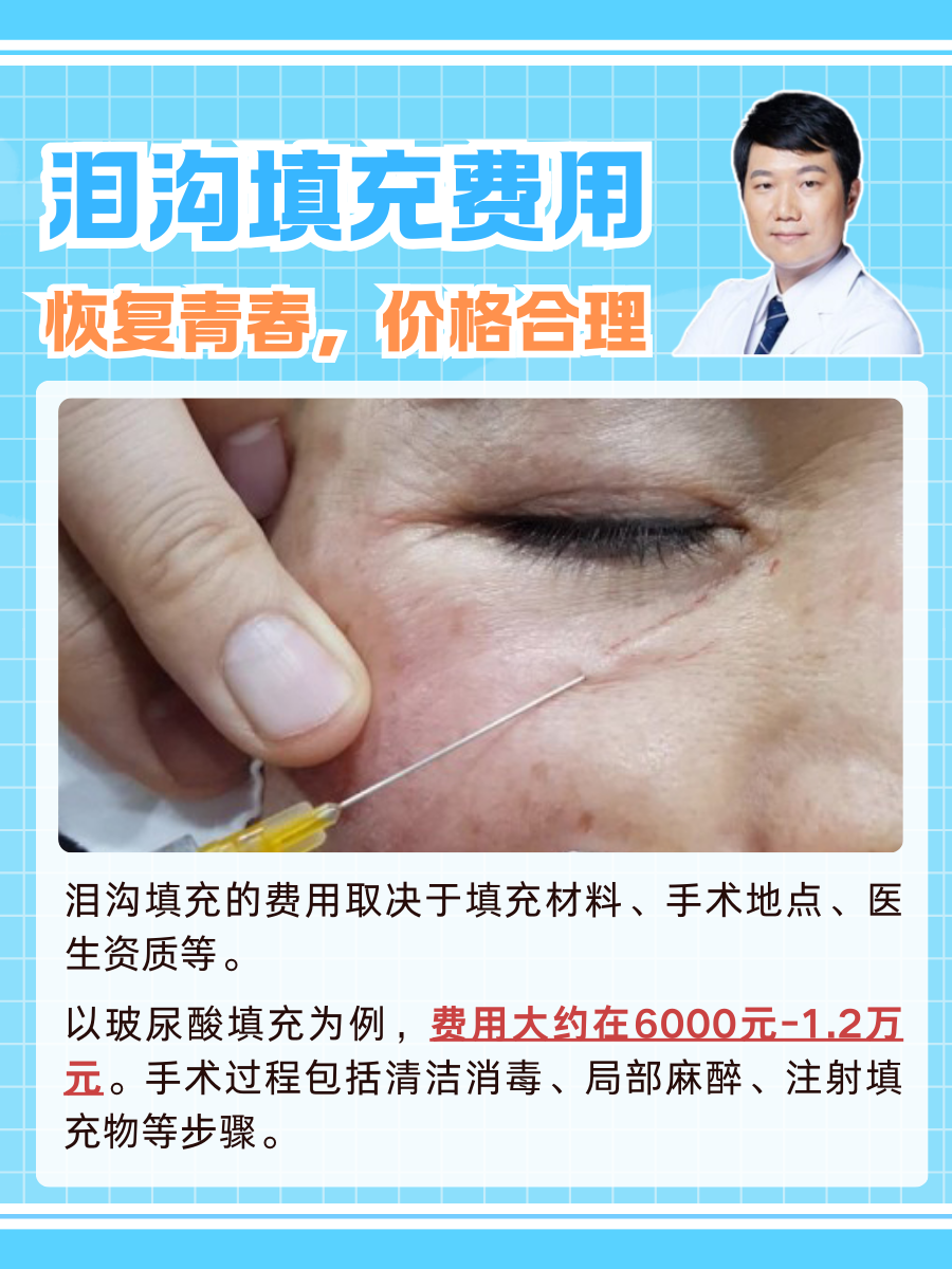 泪沟填充费用：恢复青春，价格合理