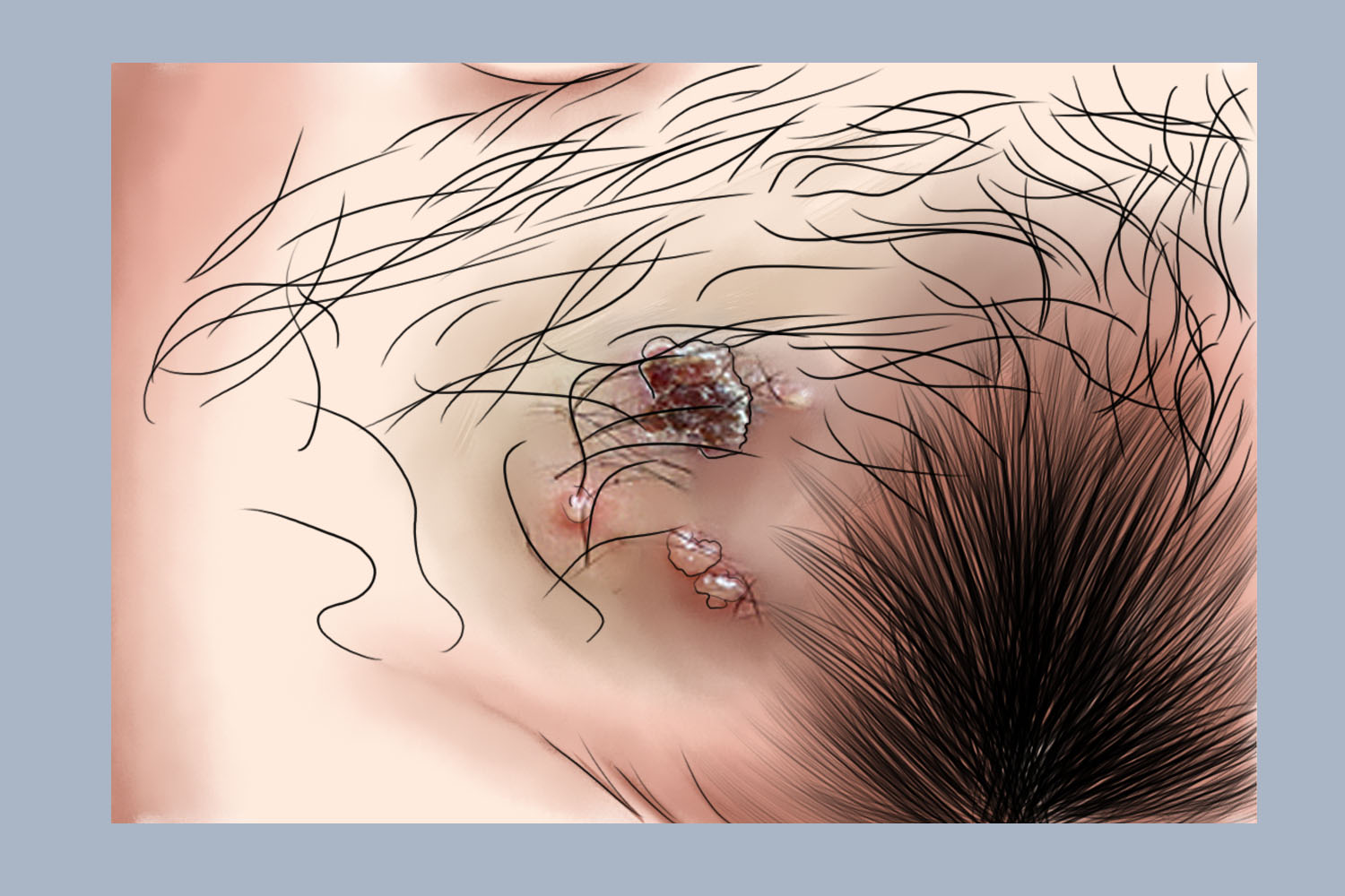 复发性生殖器疱疹破皮图 复发性生殖器疱疹破皮图