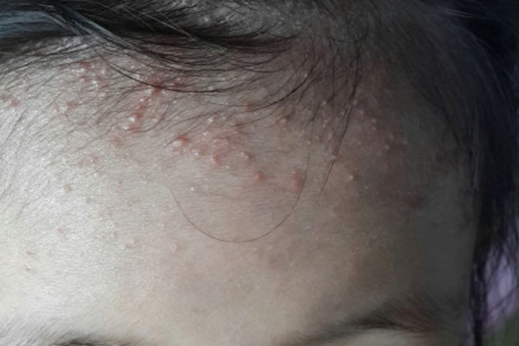 儿童痱子图 儿童痱子图