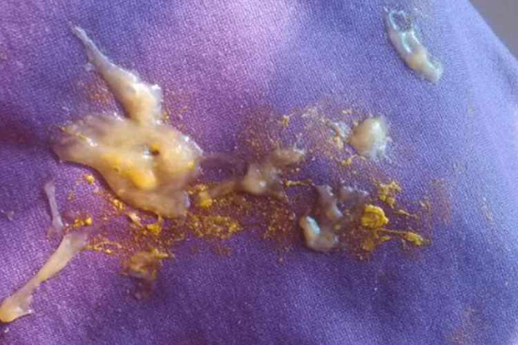 慢性细菌性痢疾胶冻样便图