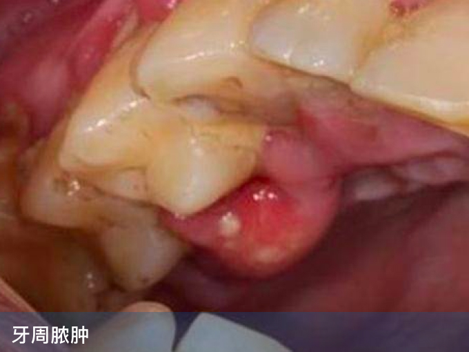 牙周脓肿
