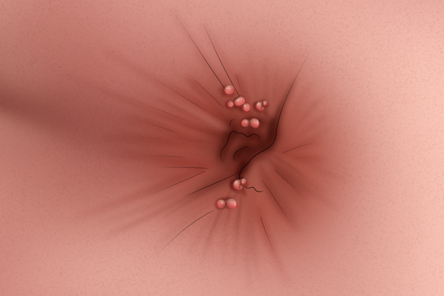 儿童感染HPV尖锐湿疣图