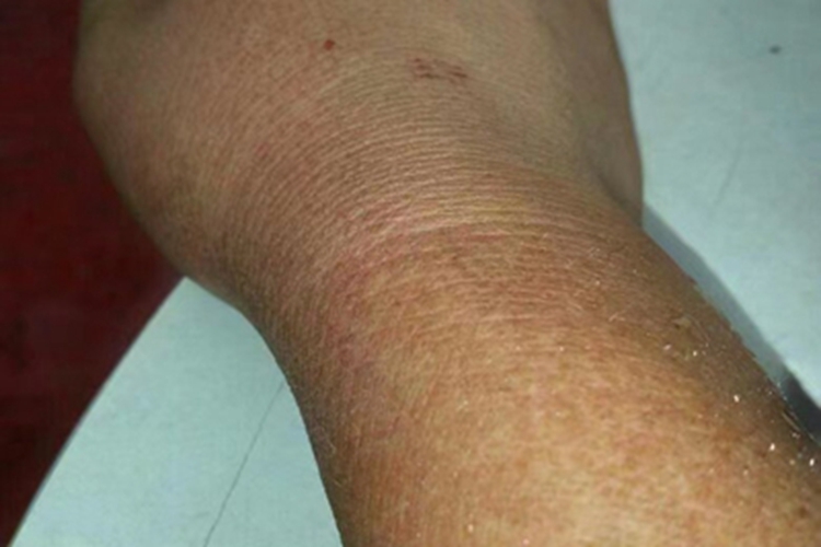 糖尿病性皮肤病手腕症状图