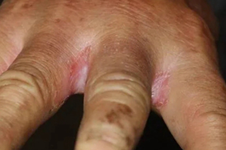 慢性黏膜皮肤念珠菌病皮肤糜烂图 慢性黏膜皮肤念珠菌病皮肤糜烂图