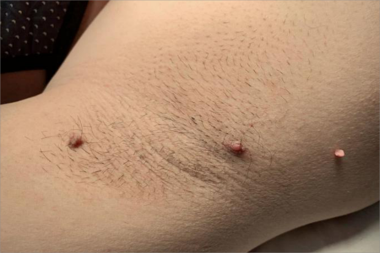 丝状软纤维瘤腋窝肉粒图