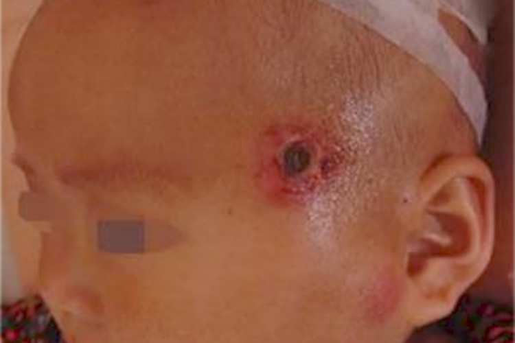 臁疮面部红斑图