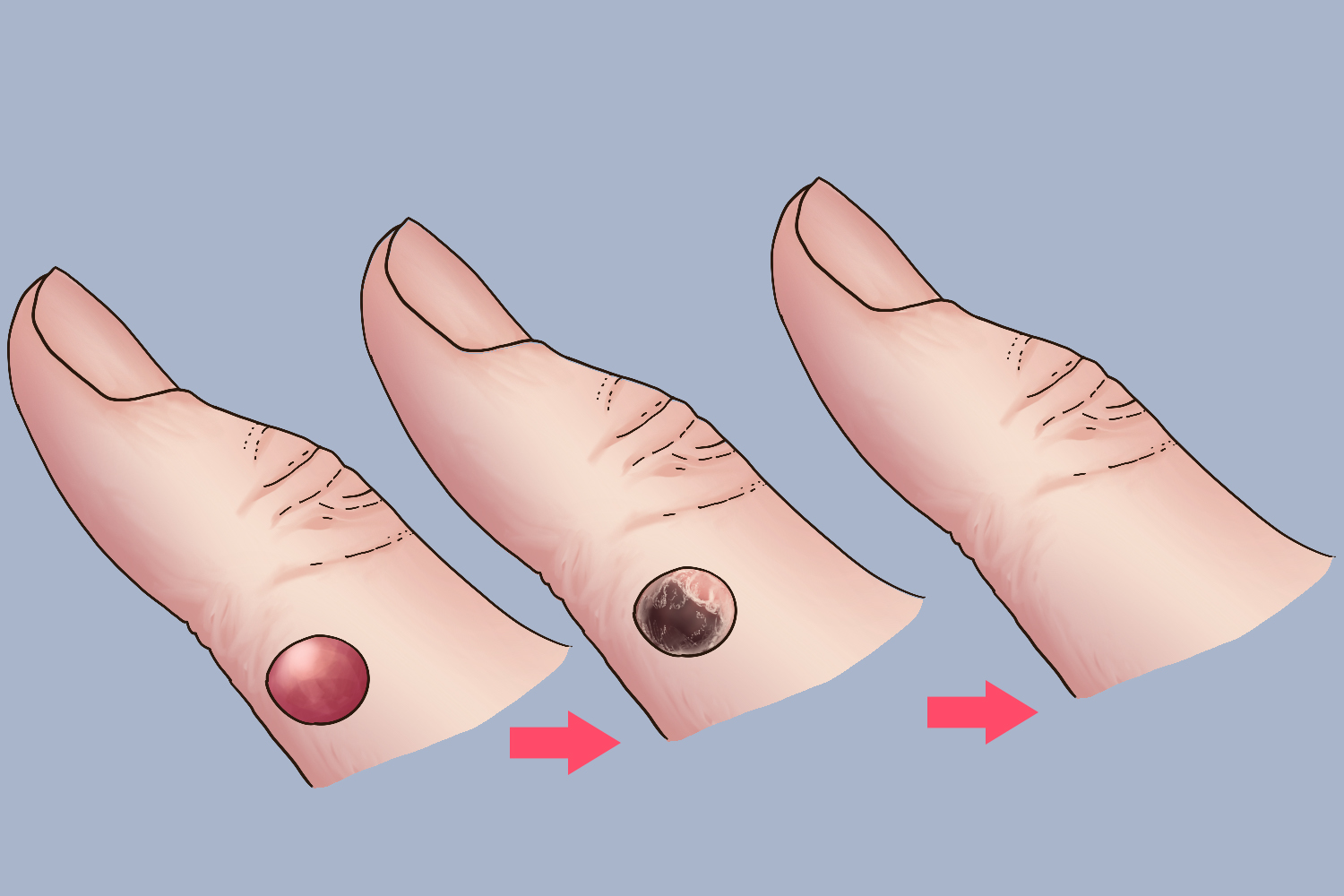 冷冻寻常疣脱落图 冷冻寻常疣脱落图