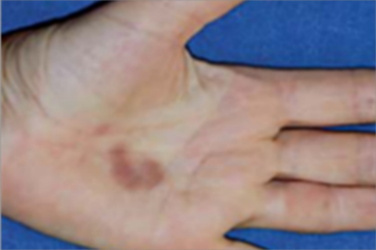 持久性隆起性红斑手掌红斑图