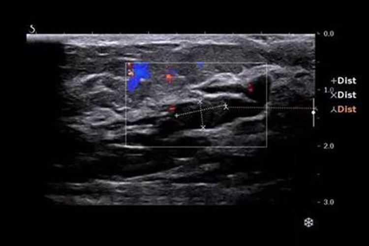 乳腺导管内乳头状瘤超声图