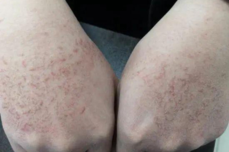 干性湿疹手背裂纹图