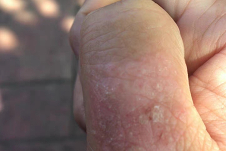 汗疱疹手指脱皮图 汗疱疹手指脱皮图