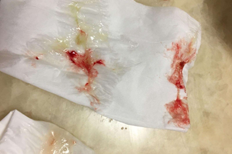 鼻腔癌脓鼻涕带血图 鼻腔癌脓鼻涕带血图