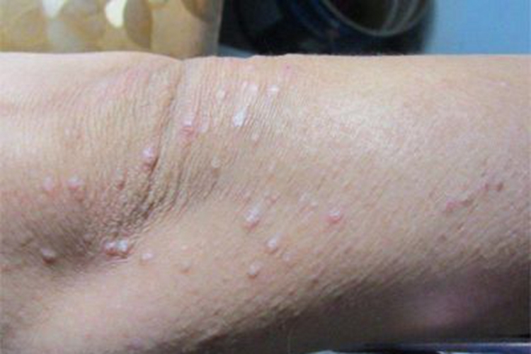 湿疹型多形性日光疹胳膊疙瘩图